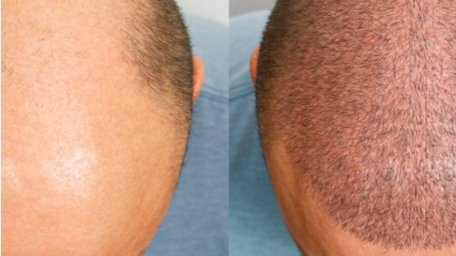 Hair Transplant Complication Insurance in Turkey: Be Secure with Health Tourism Insurance